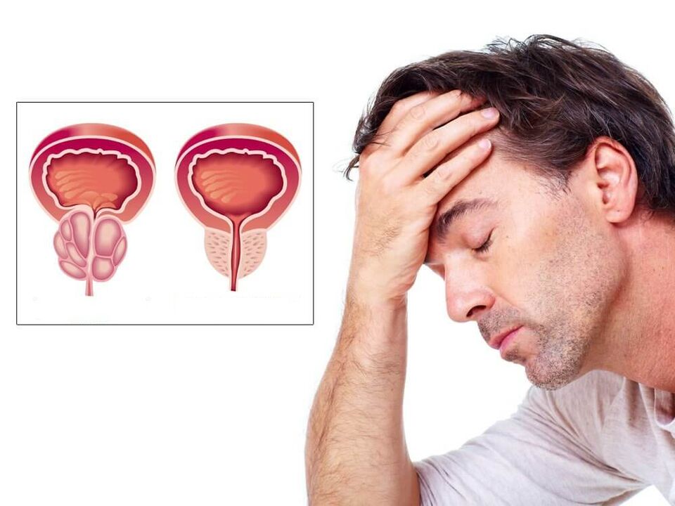 Symptômes de l'inflammation de la prostate chez les hommes