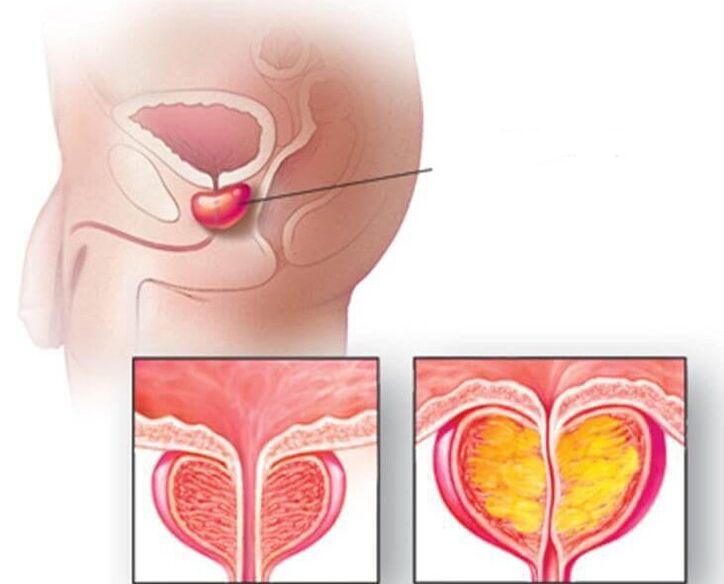Localisation de la prostate, prostate normale et hypertrophiée dans la prostatite chronique