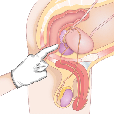 Détermination de l'état de la prostate par palpation pour diagnostiquer une prostatite