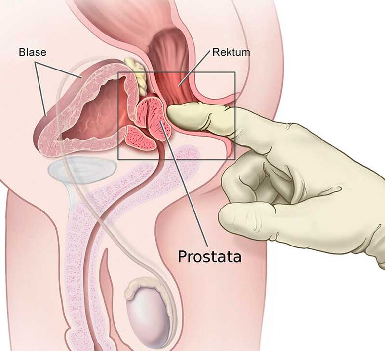 Massage de la prostate pour la prostatite