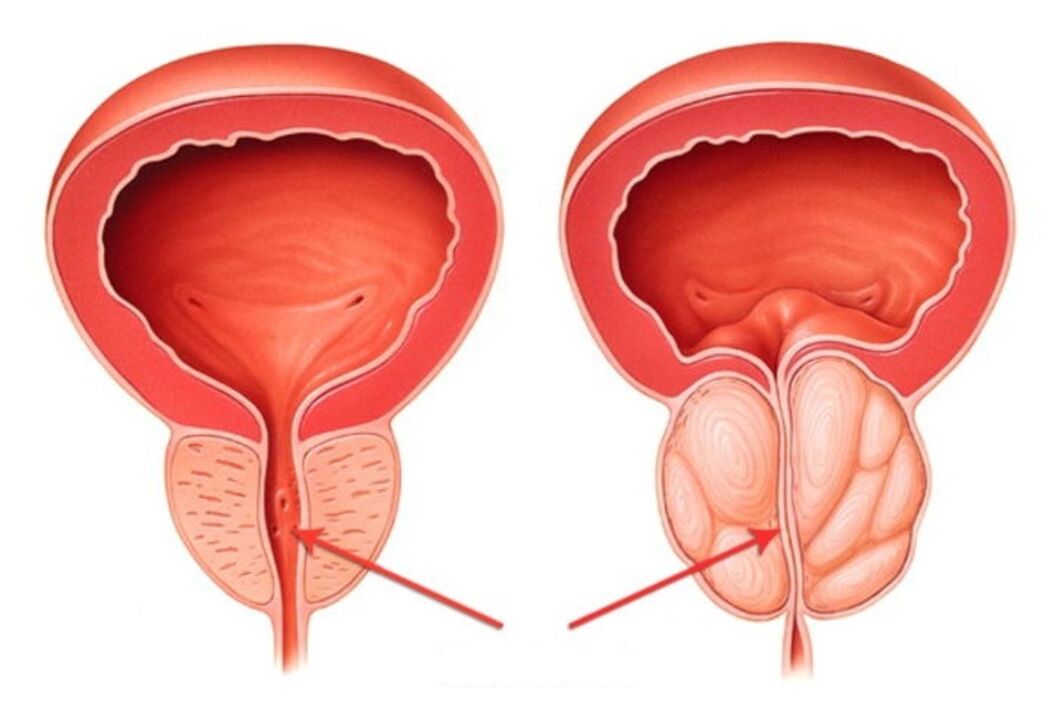 prostate saine et enflammée avec prostatite